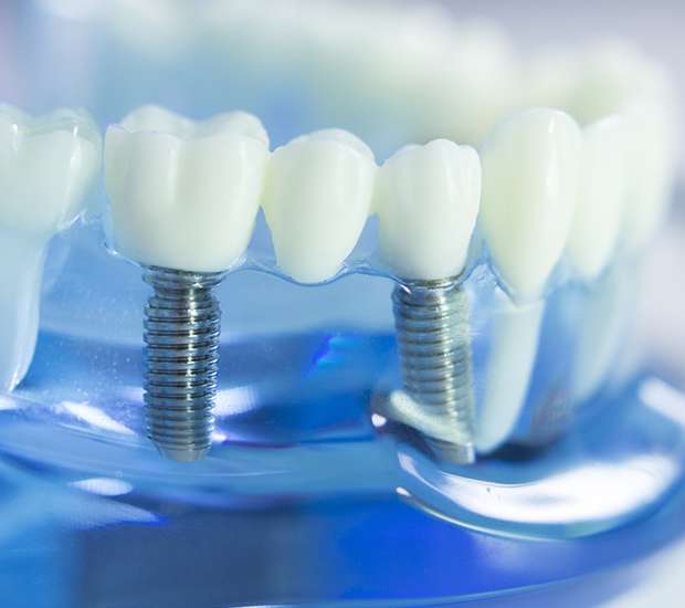 Concord Dental Implants