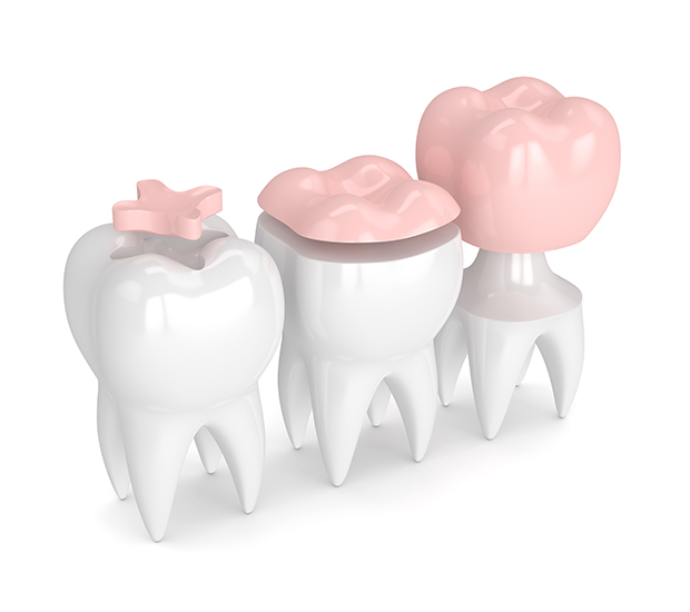 Concord Dental Inlays and Onlays