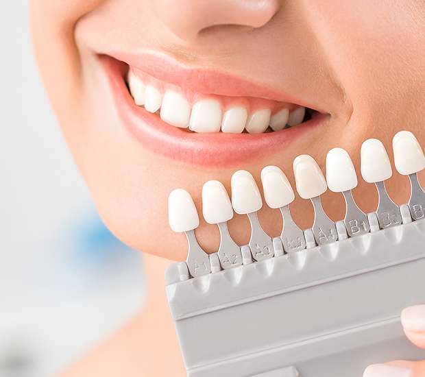 Concord Dental Veneers and Dental Laminates