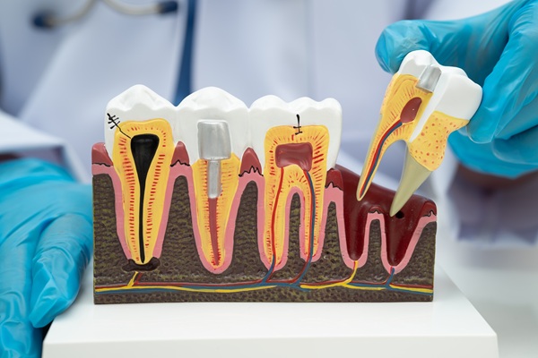 How Root Canals Prevent Permanent Tooth Loss